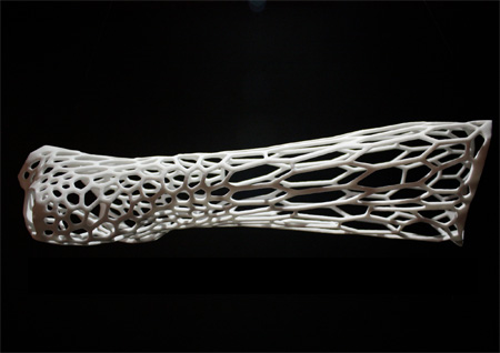 3D Printed Orthopedic Cast