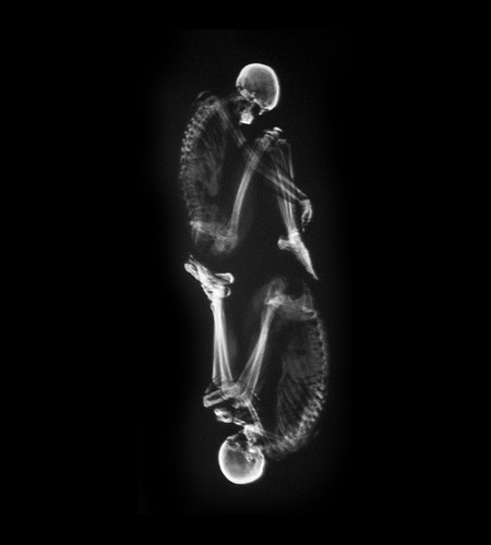 X-Ray Photos of People
